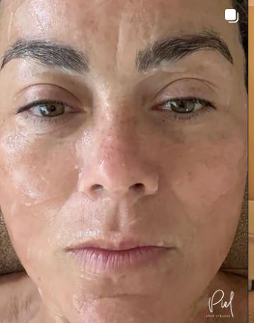 Mascarilla facial durante tratamiento de piel